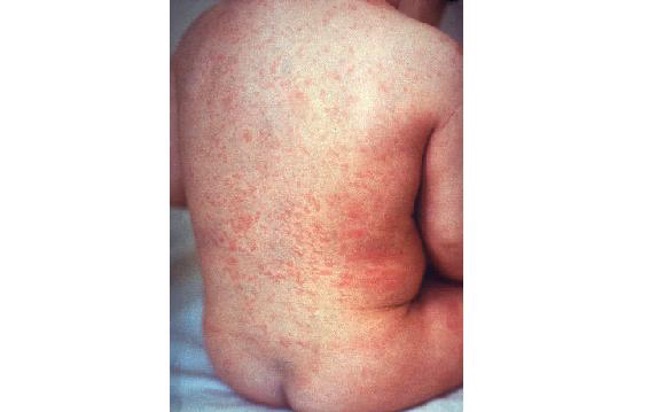 A red and bumpy rash covering a child's back and stomach.