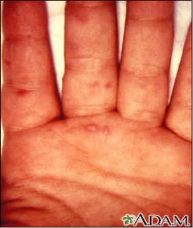 Close up view of a blister outbreak on a child's palm and fingers.