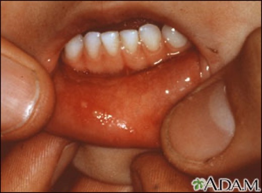 Close up view of a blister outbreak on a child's inner bottom lip.