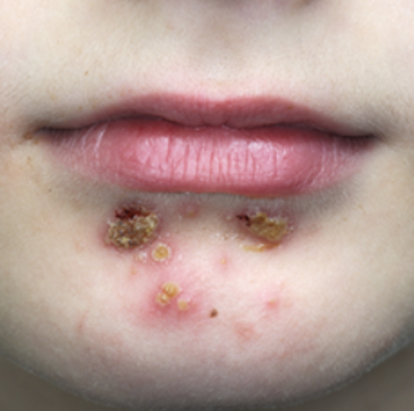 Yellow and infected looking blisters and scabs on a child's chin.