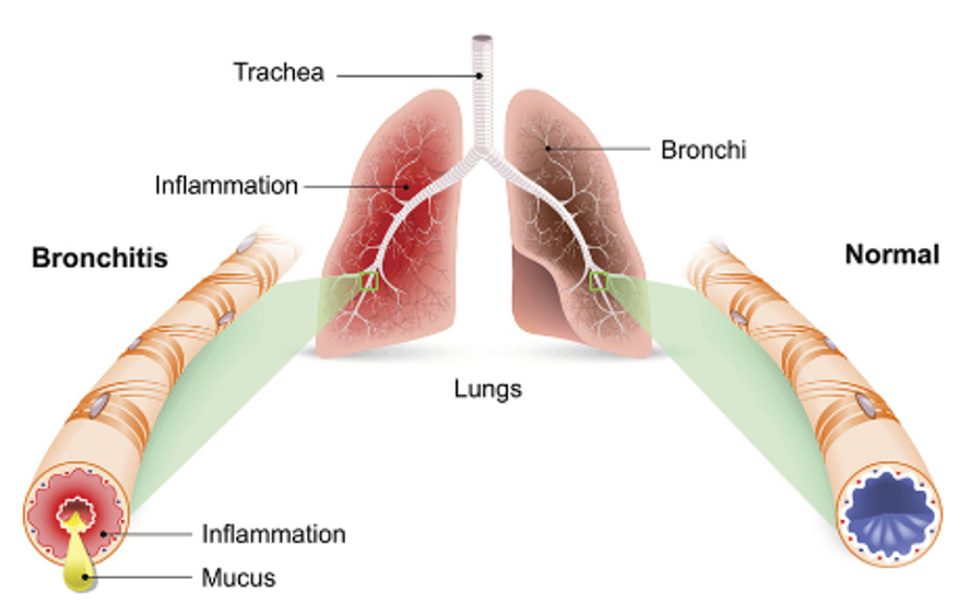 Anatomical image of healthy lungs versus lungs with bronchitis.