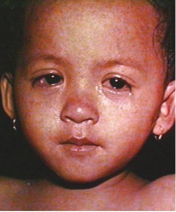 A child's face appears red and eyes appear watery.