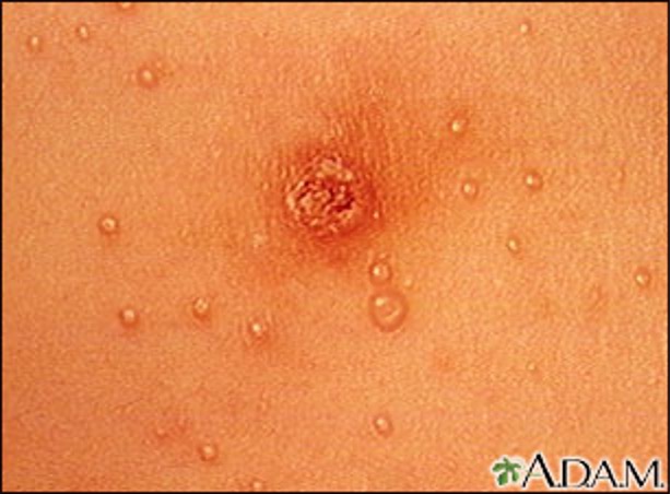 A close up view of raised blisters on the skin.