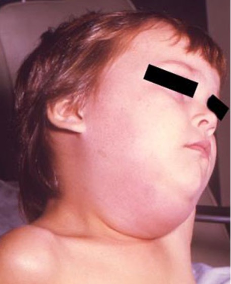 A child's face appears very swollen and pink.
