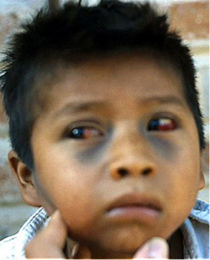 A boy's eyes are red from broken blood vessels and he has black and blue bruises under his eyes.