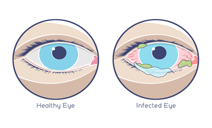 Two eyes shown side-by-side. One is a healthy eye and the other has pink eye.