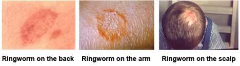 Three images of red and orange circular rashes on the skin and the head.