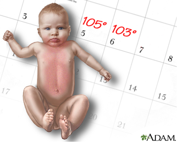 A cartoon image of a baby with a red rash all over the front of their body.