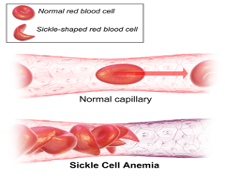 A scientific diagram of normal red blood cells versus sickle cells.