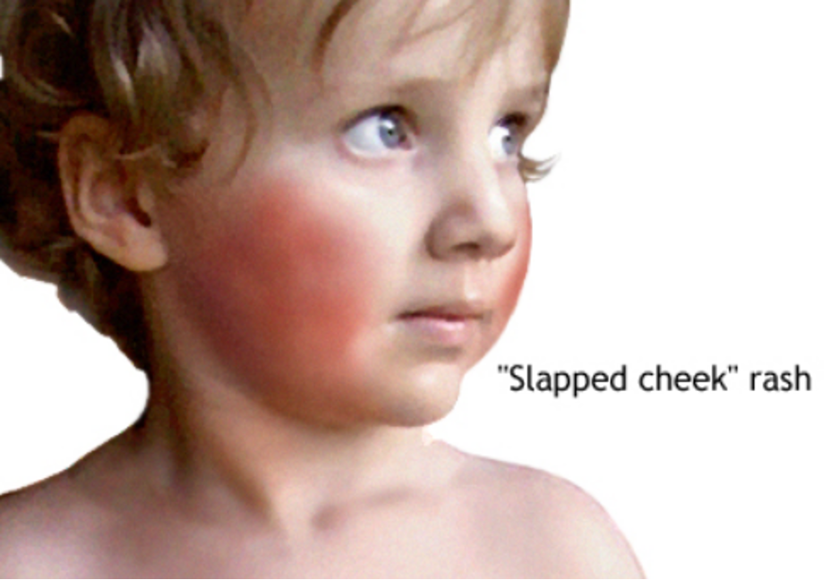 Child with very red and rashy cheeks.