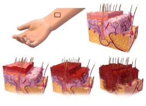 Anatomical images of the underlayers of skin and how various burns levels affect it.