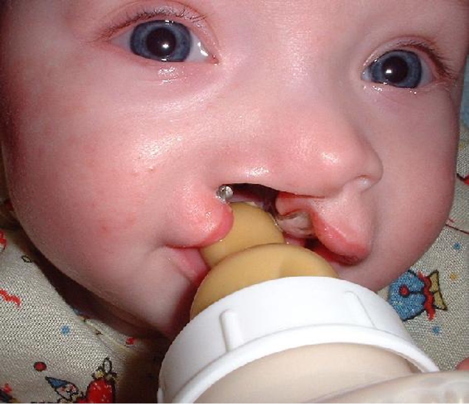 A baby with a cleft lip with a bottle in their mouth.