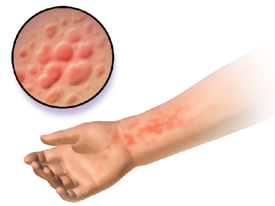 A cartoon diagram of an arm with a rash alongside a close-up image of the rash.