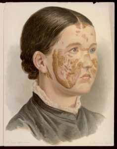 A portrait illustration of a young white woman. The figure is looking to the right and has tied back short brown hair and wears a black top with lace decoration around the neckline. All over the figure's face are dark yellowish-brown patches of colour on her forehead, cheeks, nose and below her right ear.