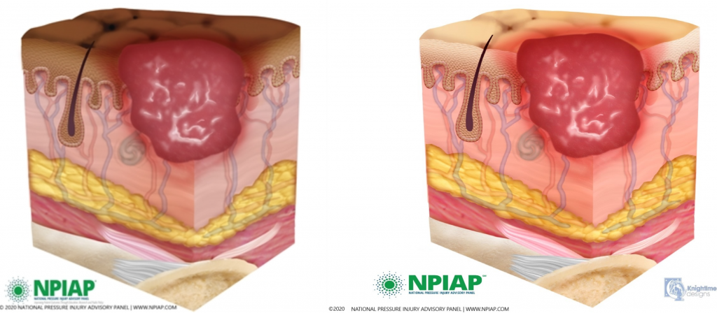 Image showing stage 2 pressure injury on both dark and light pigmented skin