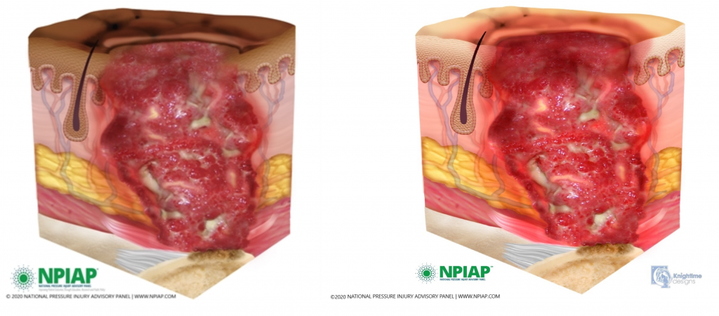 Image showing stage 4 pressure injury on both dark and light pigmented skin