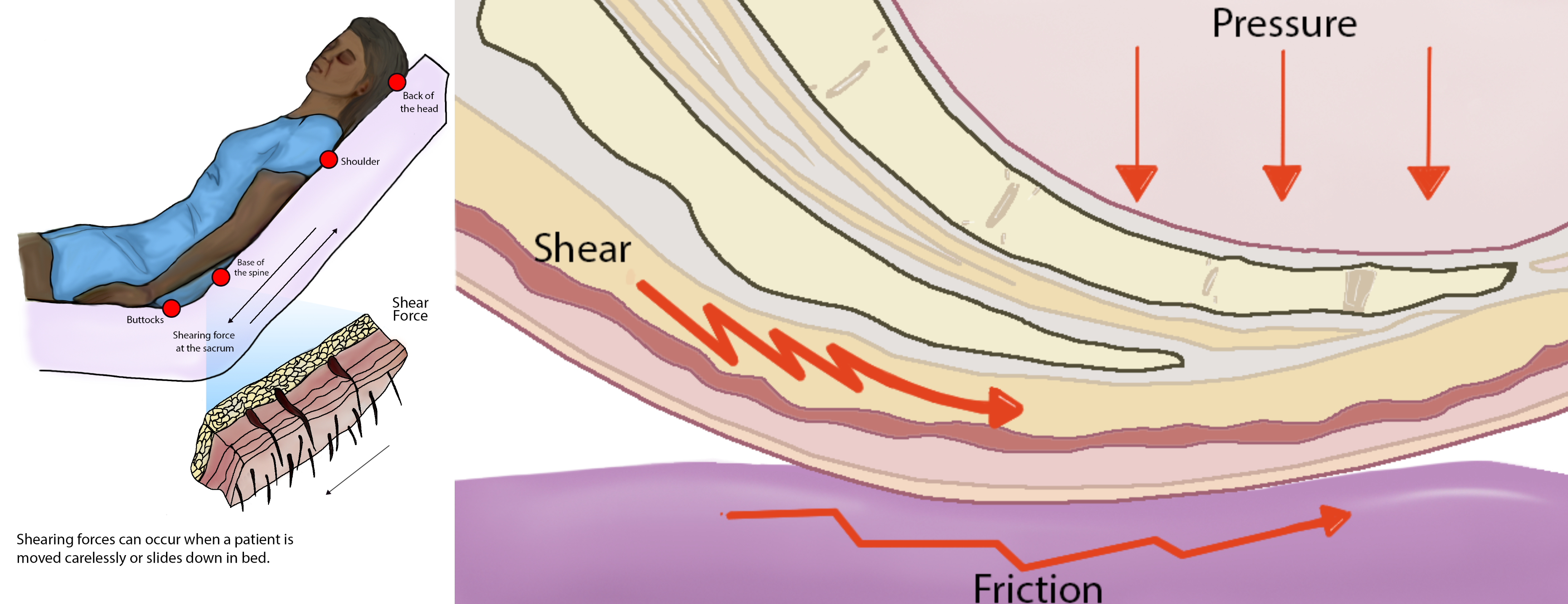 Images showing Development of Pressure Injuries