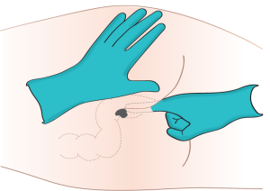 Administering medication rectally