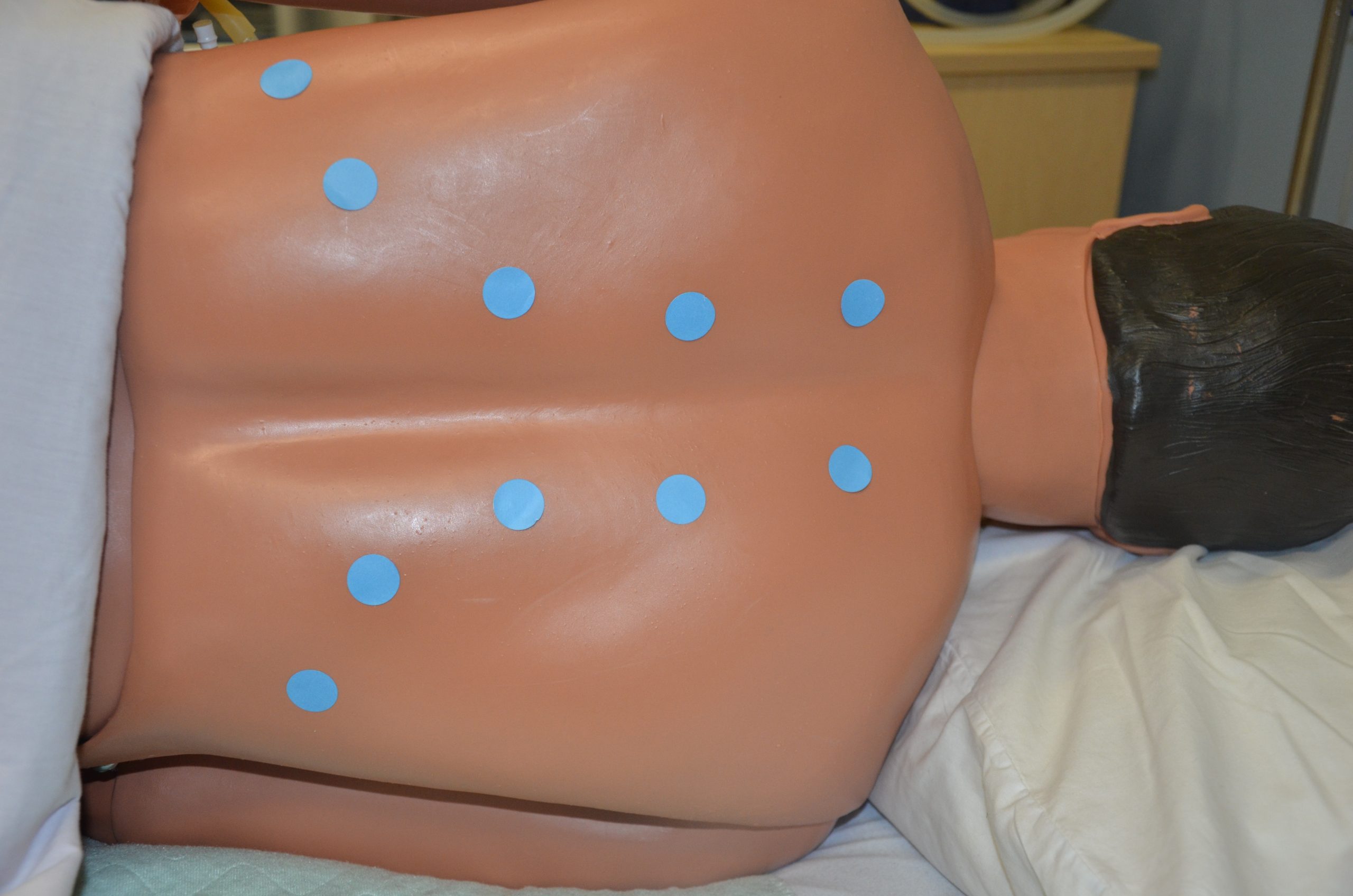 Auscultate posterior chest; blue dots placed following shoulder blades, five on each side running in an arc