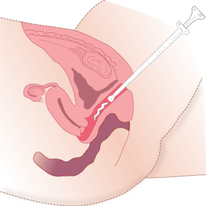 Administering medication vaginally using an applicator