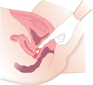 Administering medication vaginally without an applicator