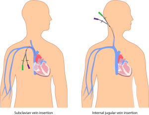 Central venous catheters