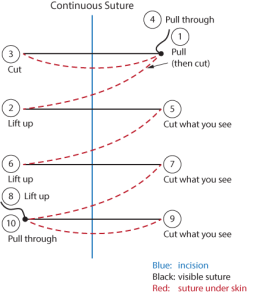 Continuous suture removal guide