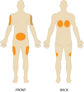 SC injection sites