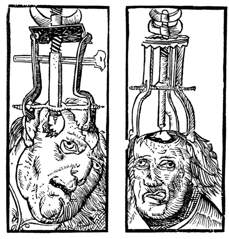 Engravings from 1525 showing trephination. It was believed that drilling holes in the skull could cure mental disorders