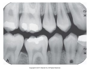 A diagnostic dental radiograph image showing a set of teeth with fillings and details of dental structure labeled as "A"