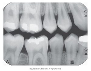 A diagnostic dental radiograph showing a detailed view of upper and lower teeth with visible dental fillings and roots.