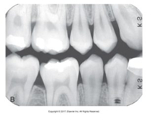 A dental radiograph labeled "B", demonstrating the effects of decreased kilovoltage, showing less contrast compared to a standard exposure.