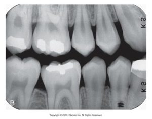 A dental X-ray image displaying upper and lower teeth, with differences in exposure likely due to an increase in kilovoltage.