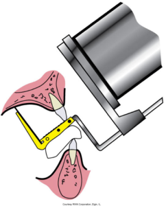 An illustration of a dental X-ray beam alignment device, showing how it positions the film and the x-ray tube for an accurate exposure.