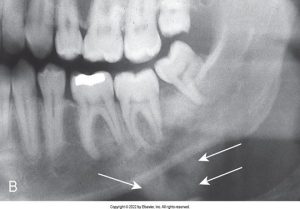 A dental X-ray showing the side view of a jaw with arrows pointing to specific teeth, possibly indicating areas of interest or concern.