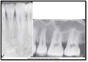 Two periapical dental X-rays: Image A shows the details of the root structures, while Image B displays the crowns of the posterior teeth.