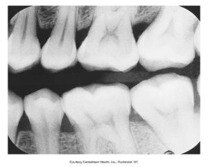 A dental bite-wing X-ray displaying the upper and lower posterior teeth, typically used to detect interproximal decay and evaluate bone levels, provided by Carestream Health, Inc., Rochester, NY.