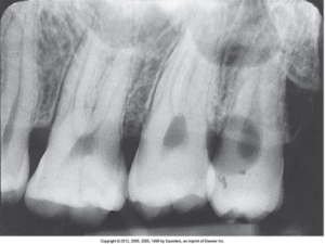 Dental X-ray showing a set of upper teeth with visible dental fillings and signs of cavities and developer spots appear dark or black.