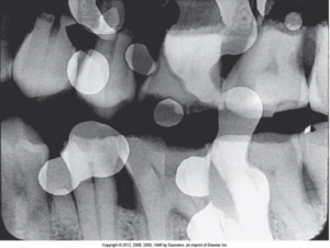 A dental X-ray depicting multiple teeth with dental work and amalgam fillings, with some areas possibly indicating decay and fixer spots appear light or white.