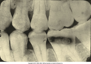 Dental X-ray showing a set of teeth with some having large fillings and dark areas that could be indicative of decay or damage and a number of processing errors may result in a yellow-brown film: exhausted developer or fixer, insufficient fixing time, and insufficient rinsing.