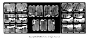 A full mouth series of dental X-rays, displaying various angles of all teeth.