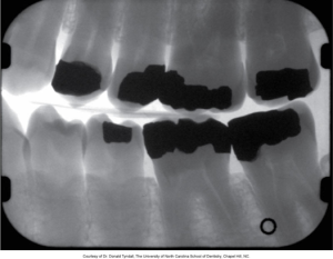 An X-ray image showing the detailed internal structure of teeth with dental fillings in bite-wing view, provided courtesy of Dr. Donald Tyndall from the University of North Carolina School of Dentistry, Chapel Hill, NC.