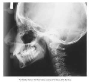 A lateral skull X-ray image, also known as a cephalometric radiograph, showing the profile of the cranial bone structure, jaw, and teeth.