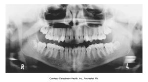 A panoramic dental X-ray image showing a full view of the upper and lower teeth and jaws, marked with "R" for the patient's right side and "L" for the left side.