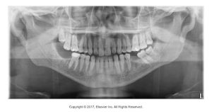 An X-ray image of a human's dental structure, showing both the upper and lower rows of teeth.