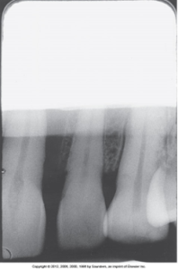 A dental X-ray showing three teeth with a clear image of the roots and surrounding bone structure, with a potential indication of a dental issue on one tooth and developer cut-off appears as a straight white border on a film on the top.