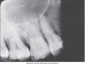 X-ray of upper teeth with a canine and molars, one tooth showing a large filling or restoration and fixer cutoff appears as a straight black border on a film on the right.