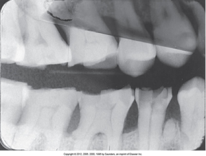 Dental X-ray showing both upper and lower teeth with amalgam fillings, and a horizontal overlapped film across the image.