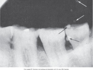 Dental X-ray highlighting several teeth with arrows pointing to the air bubbles on the image.