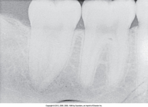 Dental X-ray showing three teeth with one exhibiting a root canal treatment and a dental crown in place with a fingernail artifact appearing as a black, crescent-shaped mark on the bottom of the image.